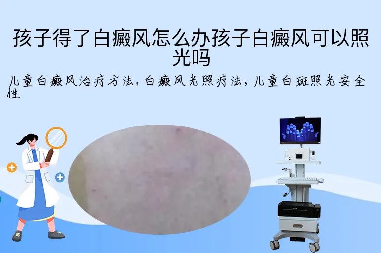 孩子得了白癜风怎么办孩子白癜风可以照光吗