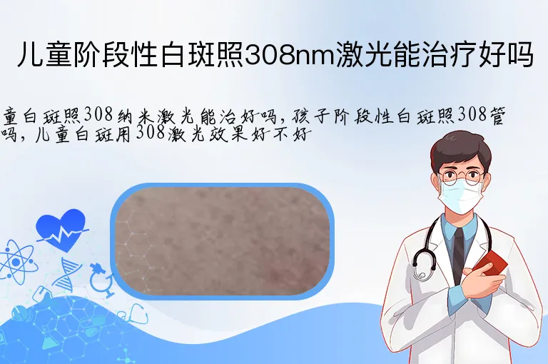 儿童阶段性白斑照308nm激光能治疗好吗