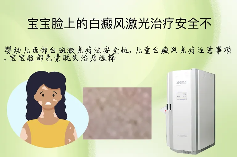 宝宝脸上的白癜风激光治疗安全不
