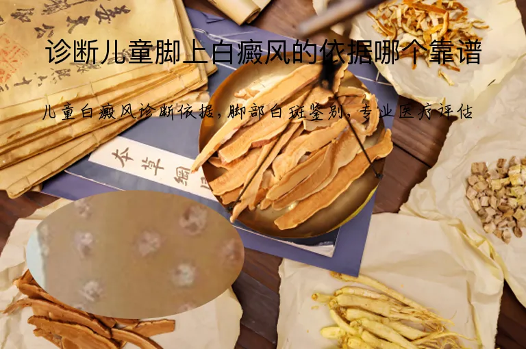 诊断儿童脚上白癜风的依据哪个靠谱