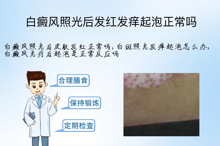 白癜风照光后发红发痒起泡正常吗