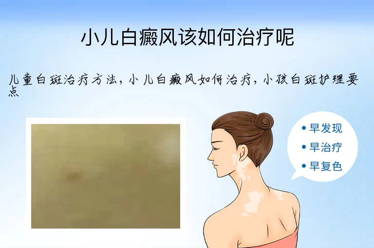 小儿白癜风该如何治疗呢