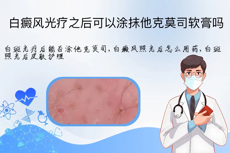 白癜风光疗之后可以涂抹他克莫司软膏吗