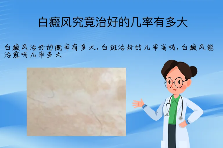 白癜风究竟治好的几率有多大