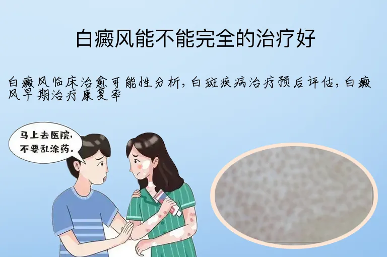白癜风能不能完全的治疗好