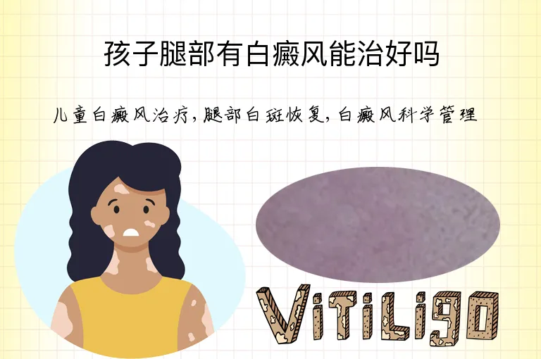 孩子腿部有白癜风能治好吗