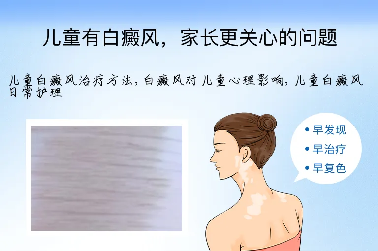 儿童有白癜风，家长更关心的问题