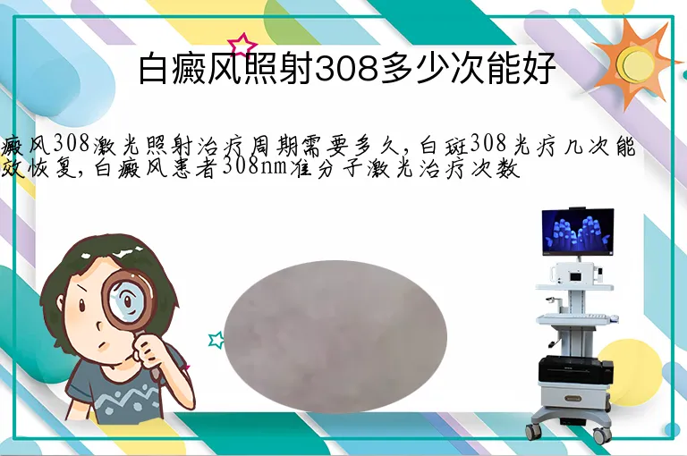 白癜风照射308多少次能好