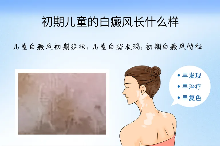 初期儿童的白癜风长什么样