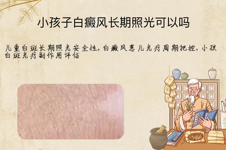 小孩子白癜风长期照光可以吗