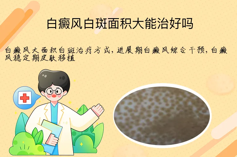 白癜风白斑面积大能治好吗