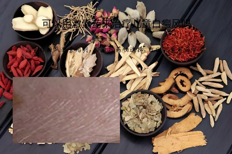 可以用激素药来治疗儿童白癜风吗