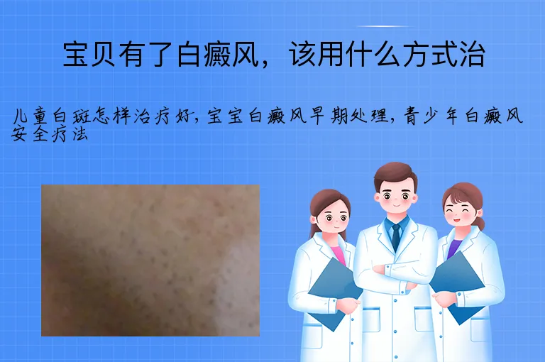 宝贝有了白癜风，该用什么方式治