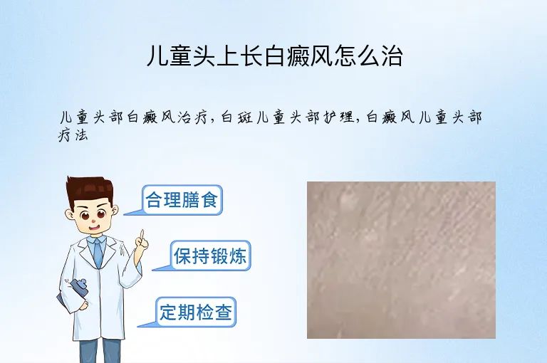 儿童头上长白癜风怎么治
