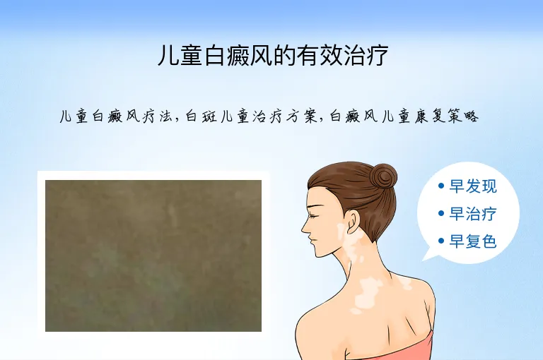 儿童白癜风的有效治疗