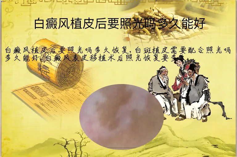白癜风植皮后要照光吗多久能好