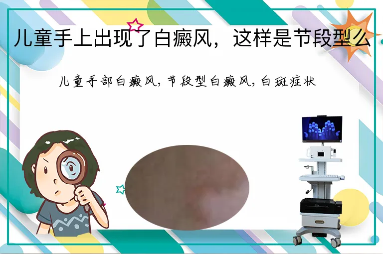 儿童手上出现了白癜风，这样是节段型么
