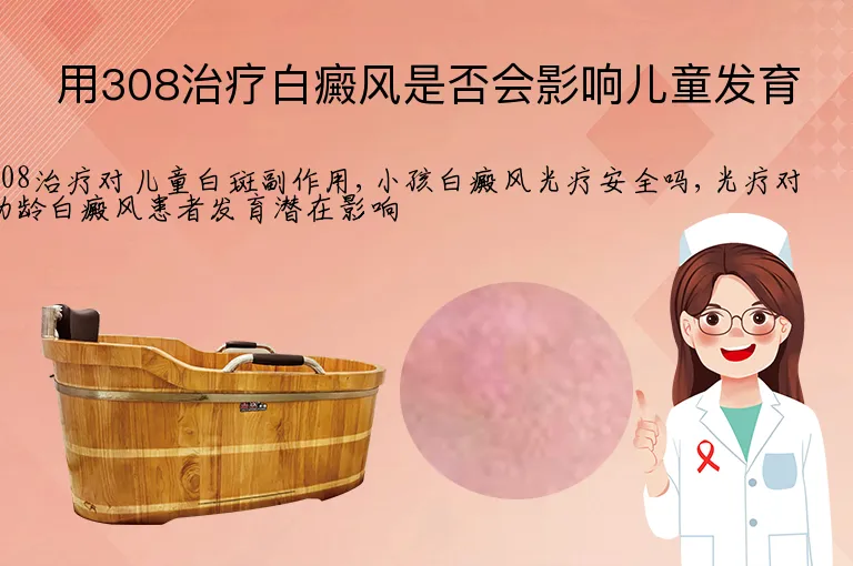 用308治疗白癜风是否会影响儿童发育