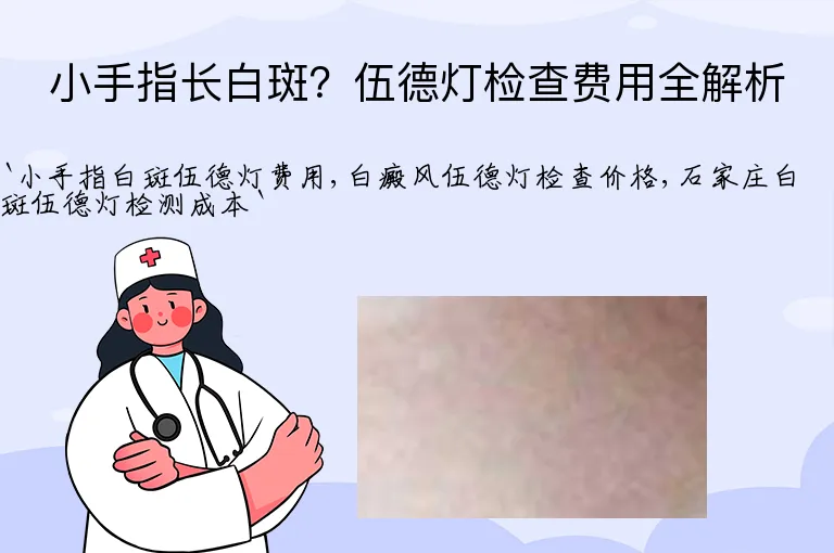 小手指长白斑？伍德灯检查费用全解析