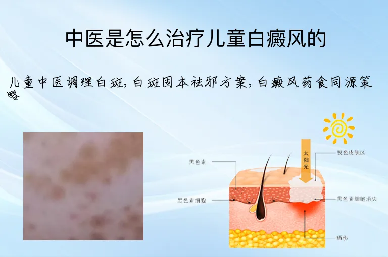 中医是怎么治疗儿童白癜风的