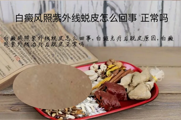 白癜风照紫外线蜕皮怎么回事 正常吗