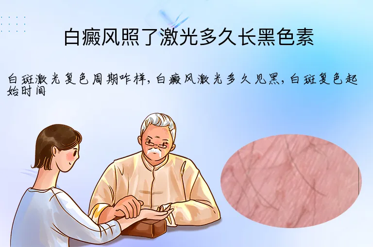 白癜风照了激光多久长黑色素