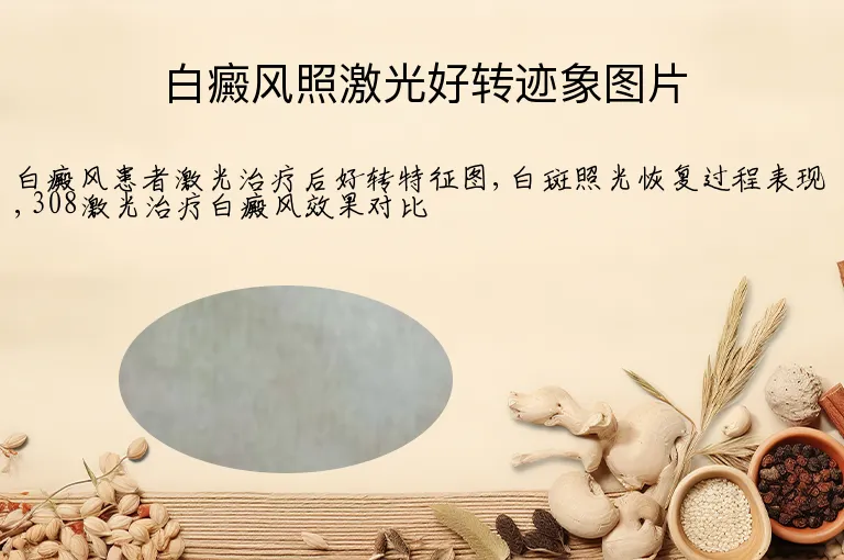 白癜风照激光好转迹象图片