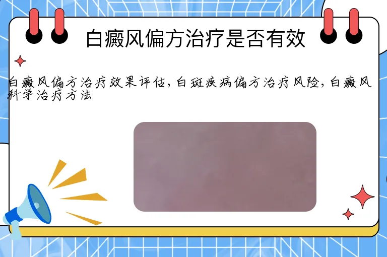 白癜风偏方治疗是否有效
