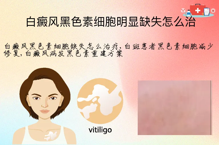 白癜风黑色素细胞明显缺失怎么治