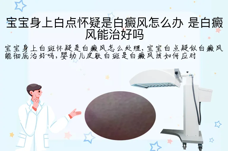 宝宝身上白点怀疑是白癜风怎么办 是白癜风能治好吗