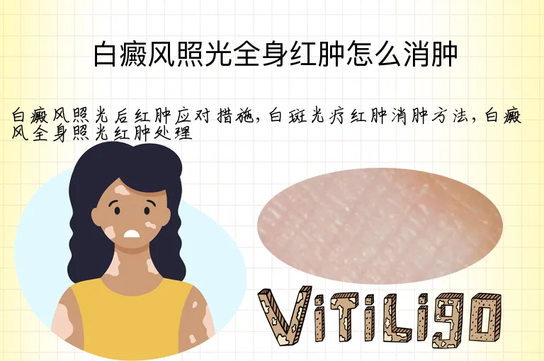 白癜风照光全身红肿怎么消肿