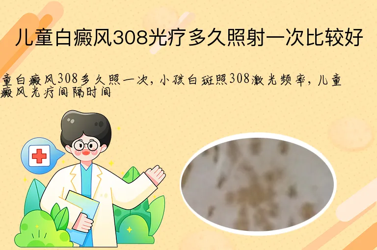 儿童白癜风308光疗多久照射一次比较好