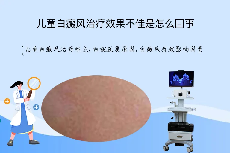 儿童白癜风治疗效果不佳是怎么回事