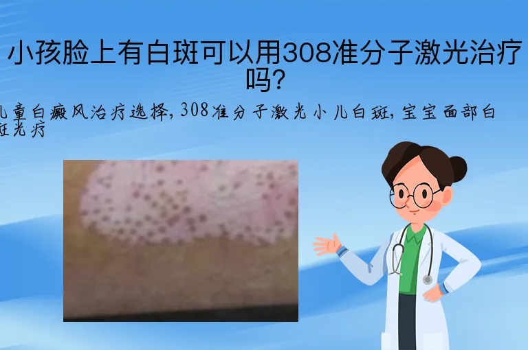小孩脸上有白斑可以用308准分子激光治疗吗？