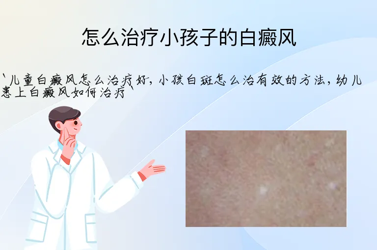 怎么治疗小孩子的白癜风