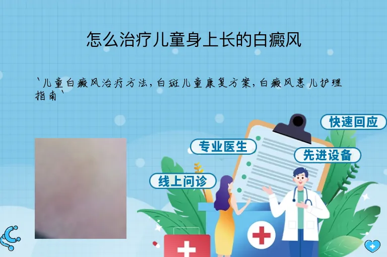 怎么治疗儿童身上长的白癜风