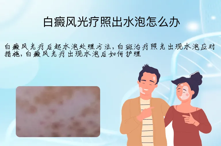 白癜风光疗照出水泡怎么办