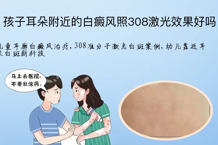 孩子耳朵附近的白癜风照308激光效果好吗