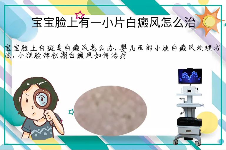宝宝脸上有一小片白癜风怎么治