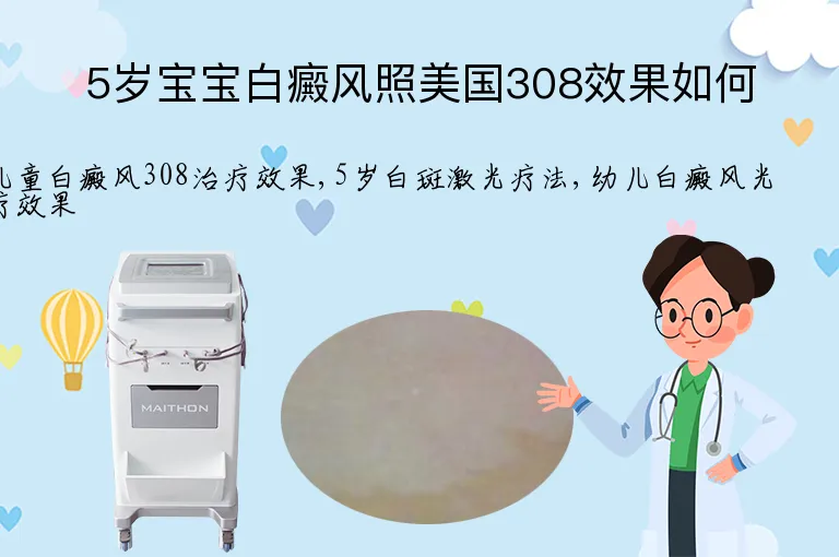 5岁宝宝白癜风照美国308效果如何