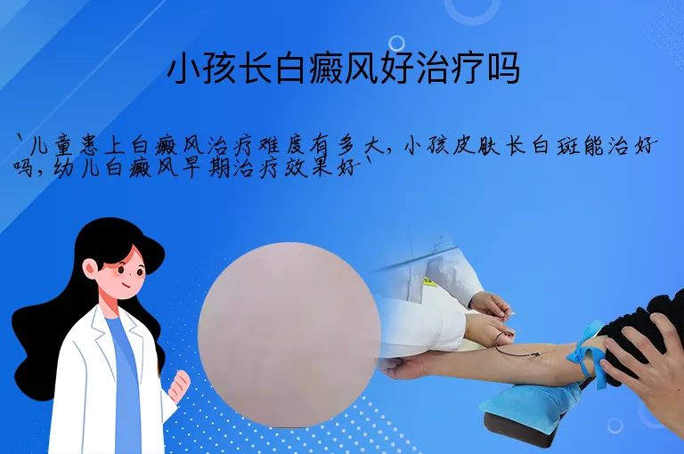 小孩长白癜风好治疗吗