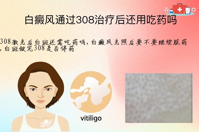 白癜风通过308治疗后还用吃药吗