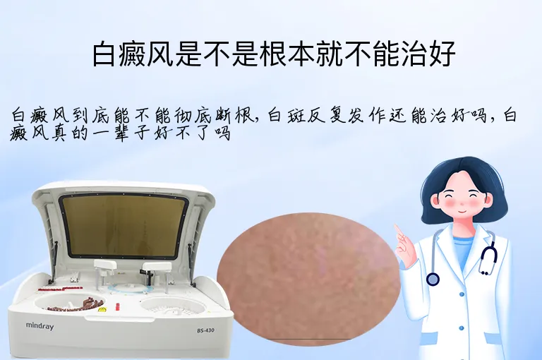 白癜风是不是根本就不能治好