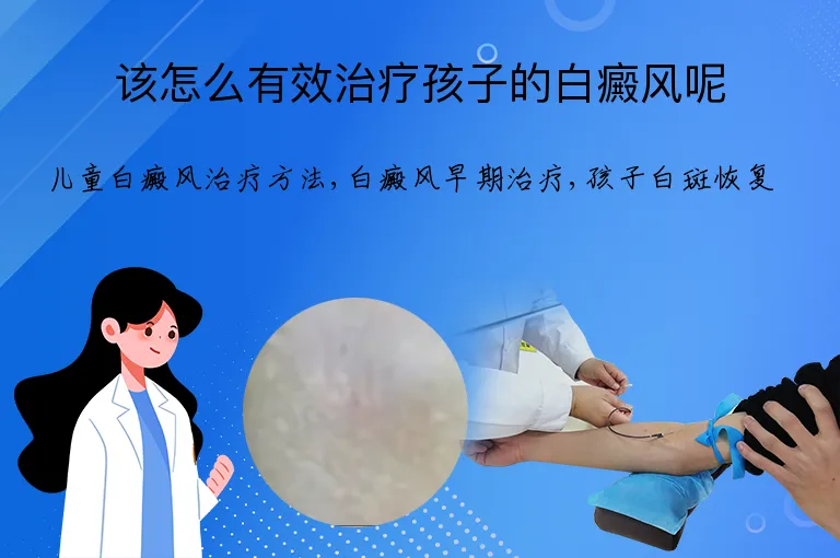 该怎么有效治疗孩子的白癜风呢