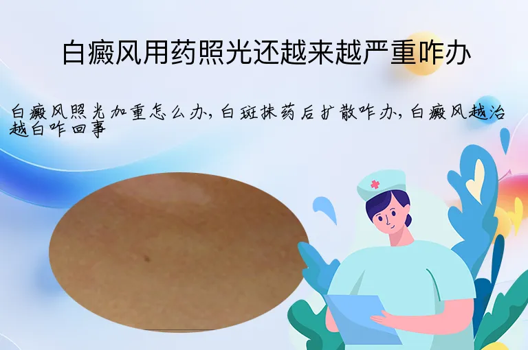白癜风用药照光还越来越严重咋办