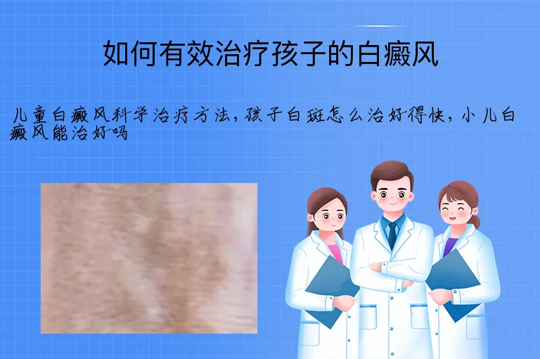 如何有效治疗孩子的白癜风