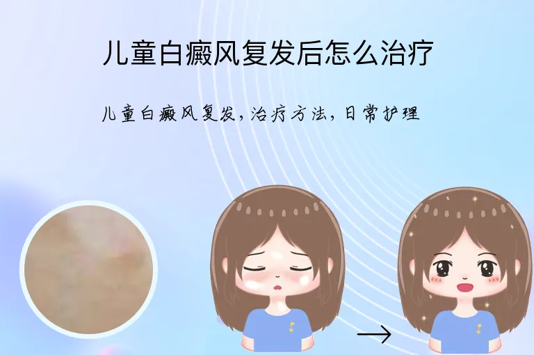 儿童白癜风复发后怎么治疗