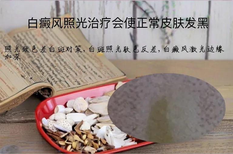 白癜风照光治疗会使正常皮肤发黑