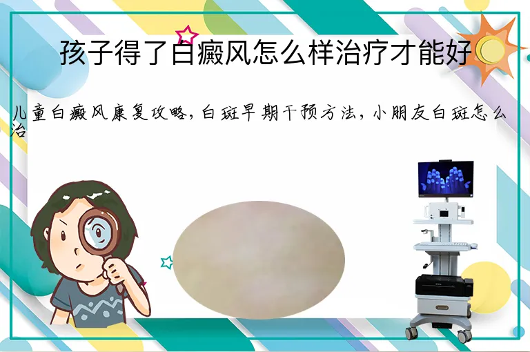 孩子得了白癜风怎么样治疗才能好