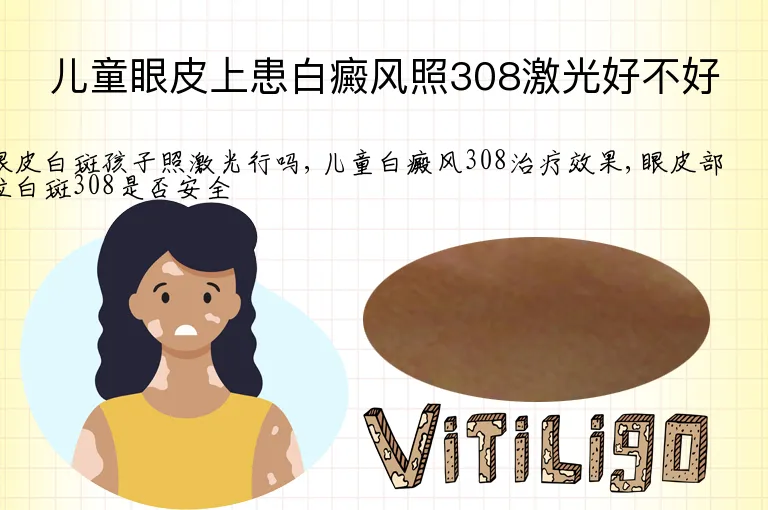 儿童眼皮上患白癜风照308激光好不好